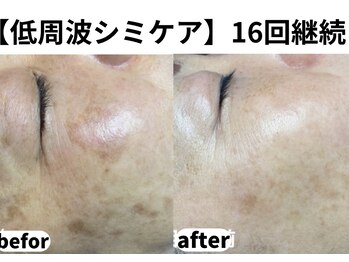 ティエル 高崎店(Tiele)/【長年のシミも諦めなくていい】