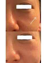 ミイン(miin)/エステ版ポテンツァ