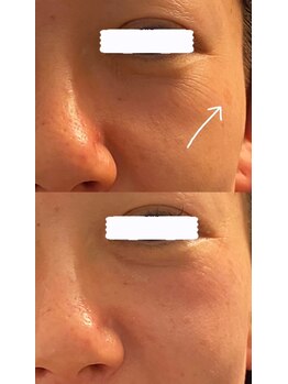 ミイン(miin)/エステ版ポテンツァ