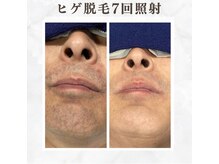 ボゴス 天白店(BOGOSS)/【ヒゲ脱毛】施術写真