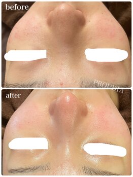 プラウディア(PROUDIA)/毛穴洗浄／毛穴悩み/いちご鼻