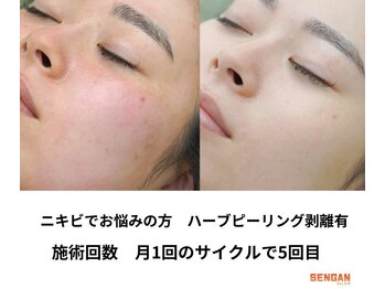 センガン(SENGAN)/剥離ハーブピーリング