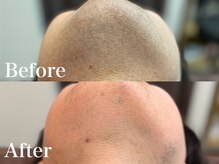 ボス 岡崎店(BOSS)/【顔脱毛/ヒゲ脱毛】口下　#脱毛