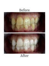 エクシアホワイトニング 相模大野店/ビフォーアフター