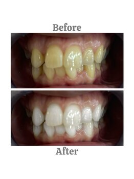 エクシアホワイトニング 相模大野店/ビフォーアフター