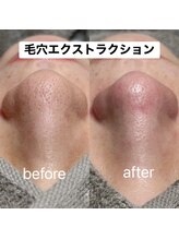 ハリサク/初回施術