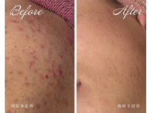 ラシック(LACHIC)/しぶといニキビもプラズマで改善