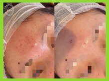 ハーブピーリング 名古屋/剥離無し　韓国ハーブピーリング