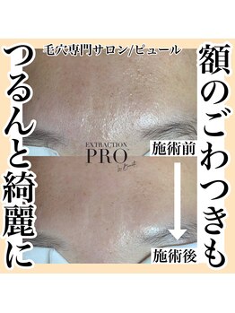 ピュール 鯖江店(PUR)/毛穴/毛穴ケア/毛穴洗浄