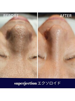 水光ピールスキン/SUPERJECTION エクソロイド5回