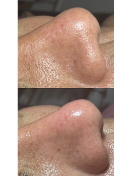 チェイル(JEIL)/黒ずみ撃退！