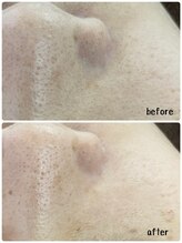 ウイ 津幡店(Ui)/ハイドラフェイシャル