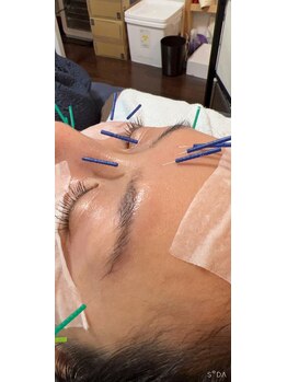 リバイバル(Re:vival)/美容鍼は細かな線にも対応◎