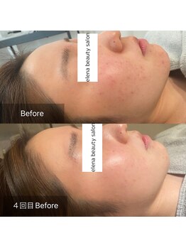 エレナ(Elena)/陶肌トリートメント