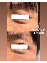 ミイン(miin)/エステ版ポテンツァ