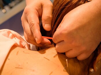 あおば鍼灸整骨院の写真/【全身おまかせ鍼コース￥7,000～】院長によるお一人おひとりのお悩みに合わせた施術◎