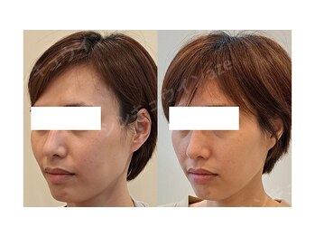 鍼灸院アゼ(AZE)/お顔の変化