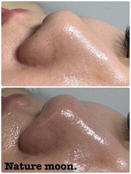 ナチュールムーン(Nature moon.)/毛穴洗浄