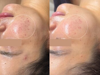 ラティエ(Latier)/【ハーブピーリング／施術1回】