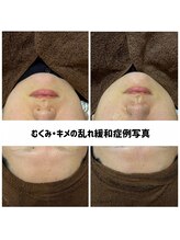 リジェ(Rege)/30代女性の方　施術