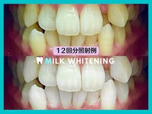 ミルクホワイトニング 新大村店(Milkホワイトニング)/★施術例