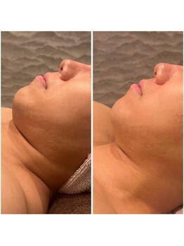 ビュウナ 銀座(BEAUNA)/マルチウェーブリフト