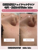 ホワイトラボ 梅田(White labo)/ハイドロ毛穴洗浄×艶肌wax