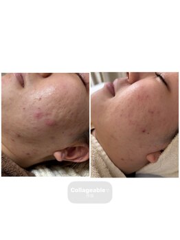 リノレア(Lino_Lea)/【ハーブピーリング】