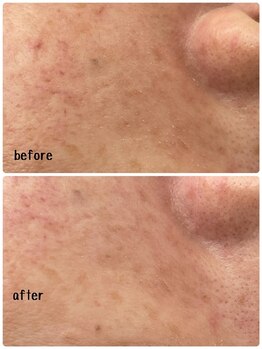 ウイ 津幡店(Ui)/毛穴洗浄