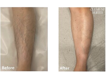 セラス(CERAS)/男性の足脱毛