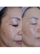 ザ シー タイムレスビューティ(THE SHE)/40代お客様症例写真