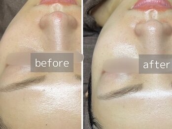 サロン ドゥメール(salon Demaile)の写真/【大人気◇韓国のツヤ肌管理*ララピール導入店】毛穴レスの水光肌を実現！ニキビケアにも◎根本肌質改善♪