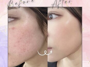 ミモアサロン 岡崎店(mimoaサロン)/話題のエクソソームフェイシャル