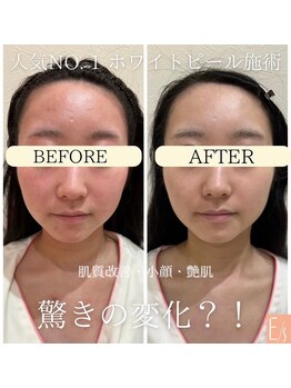 イーズスリミングプロ 横浜コレットマーレ店/ホワイトピール×ヒト幹細胞毛穴