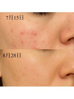 ウミ(Ummi)/漢方ハーブピーリング