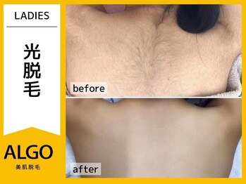 アルゴ 敦賀店(ALGO)/20代女性10回太毛×産毛にW効果