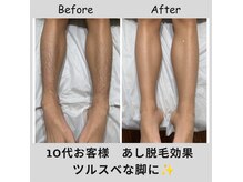 エピリス(EPILIS)の雰囲気（☆メンズ両脚脱毛お客様効果☆大人気メニューでございます！）