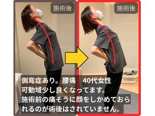 まこと整骨院/側弯あり。慢性腰痛の40代女性