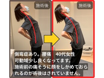 まこと整骨院/側弯あり。慢性腰痛の40代女性