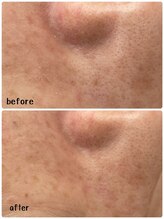 ウイ 津幡店(Ui)/ハイドラフェイシャル