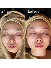 クーラ テュセ(Coeur la Tusais)/光フェイシャルと併用