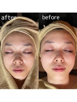 クーラ テュセ(Coeur la Tusais)/光フェイシャルと併用