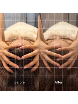 天使の艶肌/小顔矯正 before/after