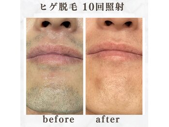 ボゴス 天白店(BOGOSS)/【ヒゲ脱毛】施術写真
