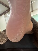 ブルーココア(BlueCocoa)/メンズかかとケアのビフォー