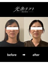 ヘルディン(heldin +555)/光糸リフト before→after