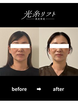 ヘルディン(heldin +555)/光糸リフト