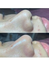 チェイル(JEIL)/黒ずみ撃退！