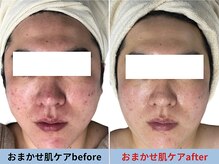 ミスターアンクール 鹿児島(Mr.uncoeur)/おまかせ肌ケア