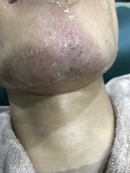 メンズ脱毛 3110R/1/パワーアップしたヒゲ脱毛